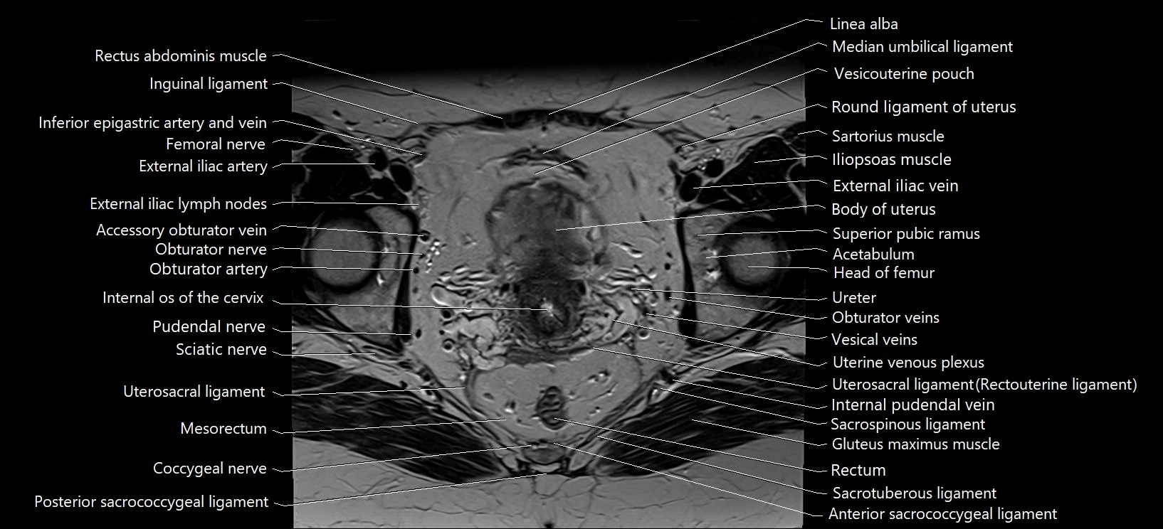 Axial cross sectional anatomy of female pelvis (MRI 3T) image 23.webp